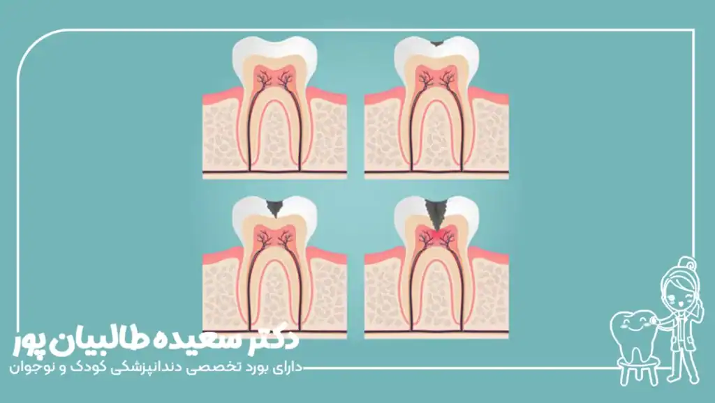 عوامل موثر بر هزینه نهایی درمان دندان شکسته کودک در سال ۱۴۰۴