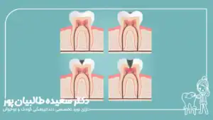 عوامل موثر بر هزینه نهایی درمان دندان شکسته کودک در سال ۱۴۰۴