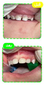 انواع شکستگی دندان در کودکان و روشهای درمانی آنها