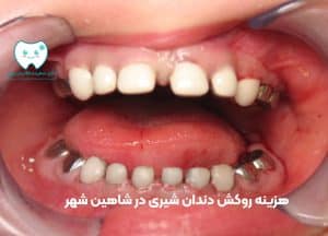 هزینه روکش دندان شیری در شاهین شهر