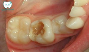 چرا دندان شیری باید ترمیم شود؟