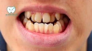 دندان دائمی کج در کودک