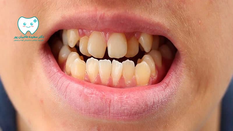 دندان دائمی کج در کودک