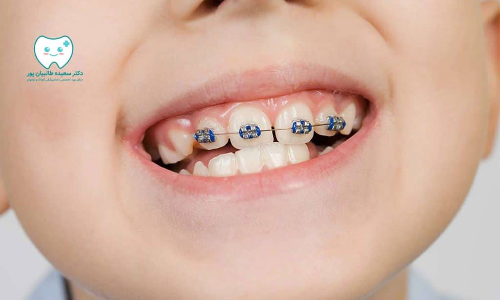 راهنمای کامل ارتودنسی پیشگیری