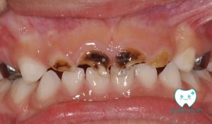 روش‌های نوین ترمیم پوسیدگی بدون تراش