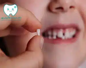 علائم طبیعی هنگام افتادن دندانها
